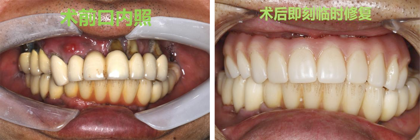 我院口腔科完成了首例半口即拔即种即刻负重当天种牙当天戴牙病例